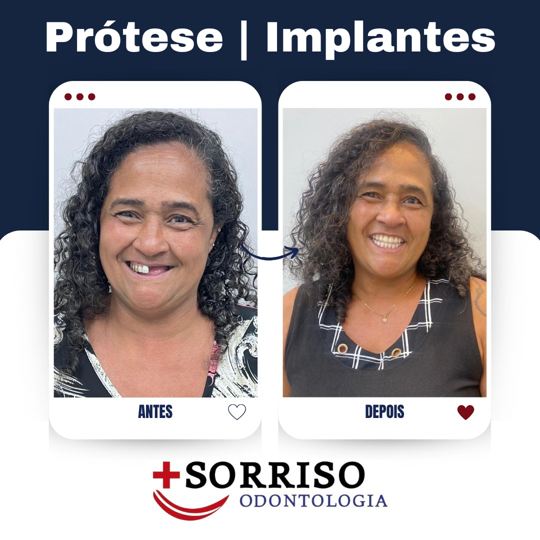 Facetas e Implantes - Antes e Depois