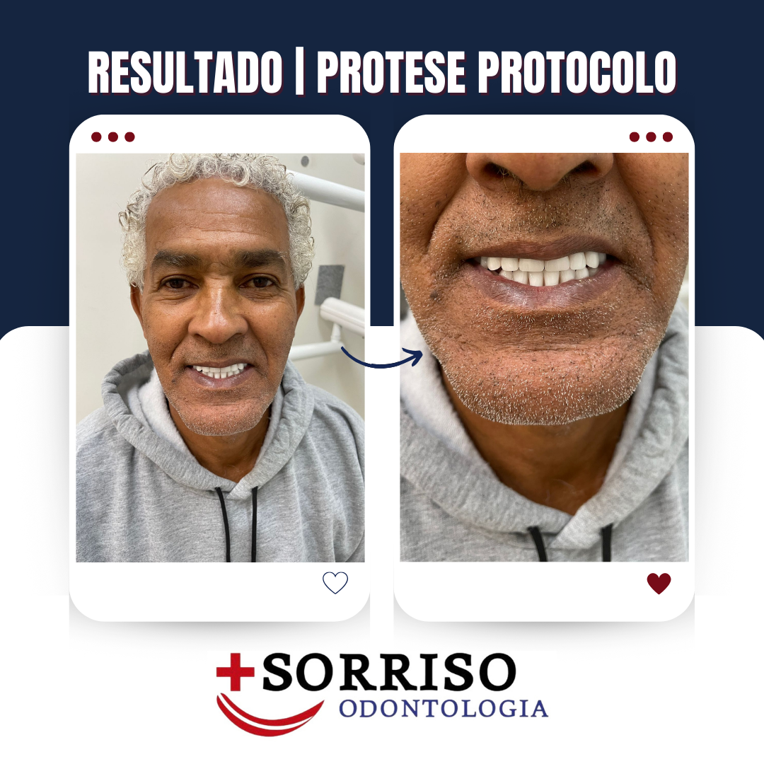 Implantes Dentários e Próteses Dentárias