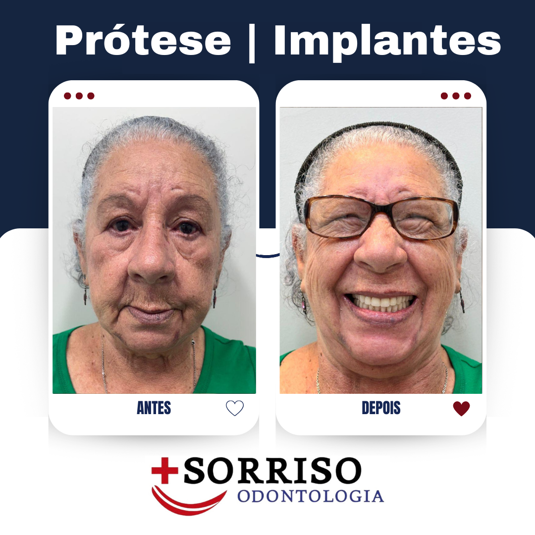 Próteses Fixas - Antes e Depois